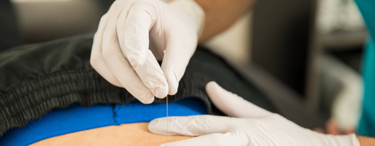 Dry Needling in Edmonton